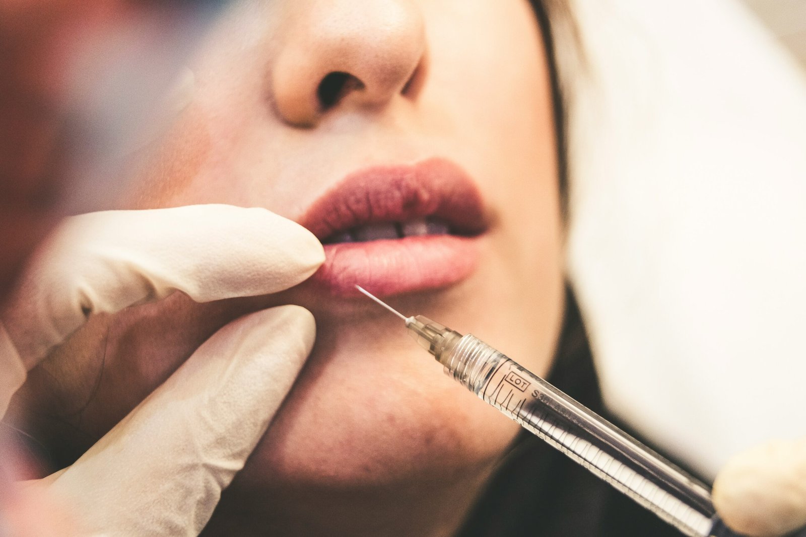 Aumento de labios con ácido hialurónico en Málaga: Todo lo que necesitas saber